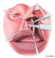 Cleft Lip Surgery
