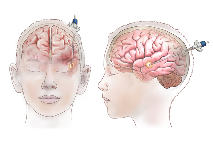 Laser ablation surgery uses a focused laser to precisely target and remove abnormal brain tissue, off ering a minimally invasive treatment option.