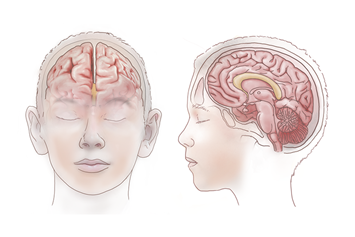 Illustration of the corpus callosum, which connects the left and right hemispheres of the brain.
