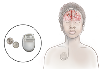 Deep Brain Stimulation