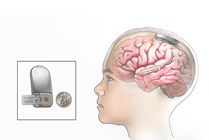 Responsive Neurostimulation (RNS)