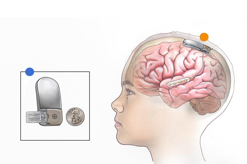 Responsive neurostimulation (RNS) uses a small device placed in the skull with wires that go to the brain. It watches for seizure activity and sends small pulses to help stop seizures before they start. 