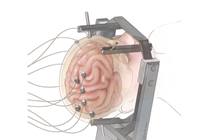Stereoelectroencephalography (SEEG)