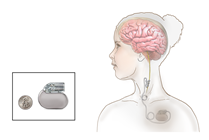 Vagus Nerve Stimulation (VNS)