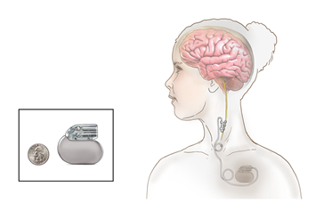 Vagus nerve stimulation (VNS) uses a small, implanted device to send regular electrical signals to the vagus nerve in the neck, helping to reduce seizures.