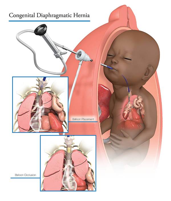 Congenital Diaphragmatic Hernia