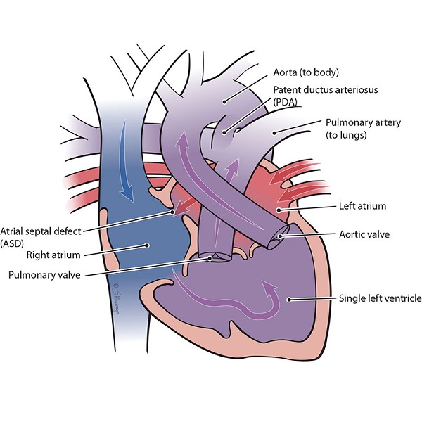 Double Inlet Left Ventricle 50 Years Of Fontan Operation 