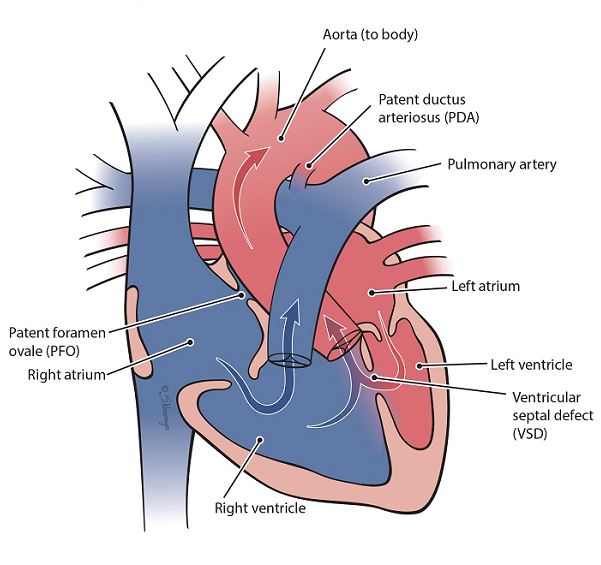Heart illustration of double outlet right ventricle (DORV)