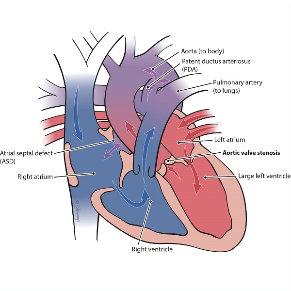Heart illustration with a aortic valve stenosis