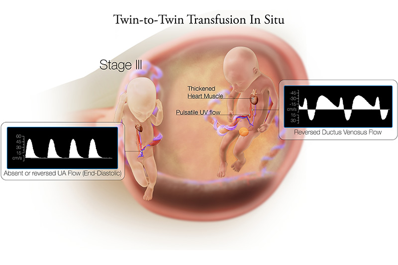 Twin to Twin Transfusion Syndrome Stage 3