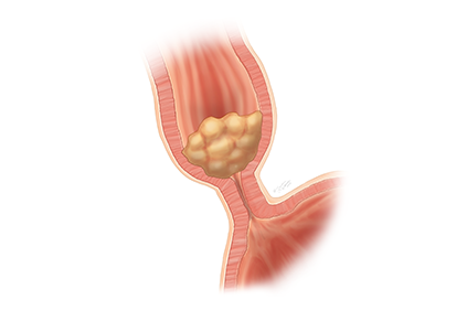 Illustration showing a tightened muscle at the bottom of the esophagus preventing food and liquid from passing easily into the stomach.