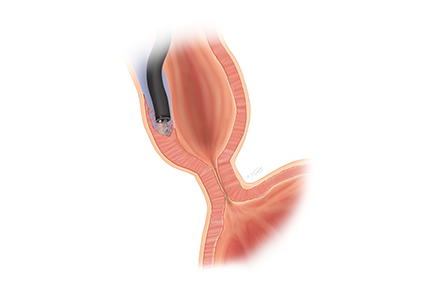Illustration showing an endoscope being guided through the esophagus toward the tight muscle area.