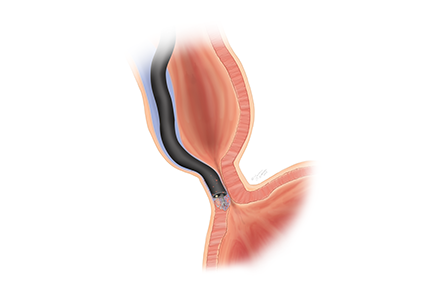 Illustration showing a small tunnel created beneath the inner lining of the esophagus to access the tight muscle.