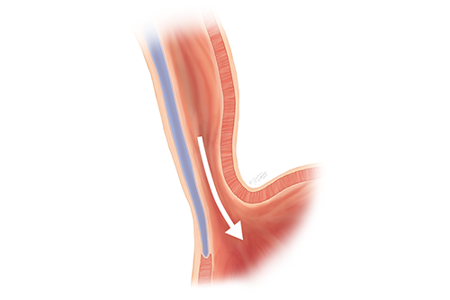 Illustration showing the tight muscle being divided to improve the passage of food into the stomach.