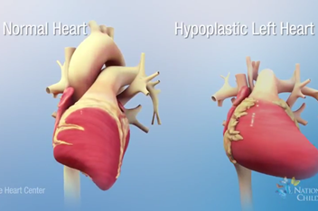 Animation: Normal Heart vs. Hypoplastic Left Heart Syndrome