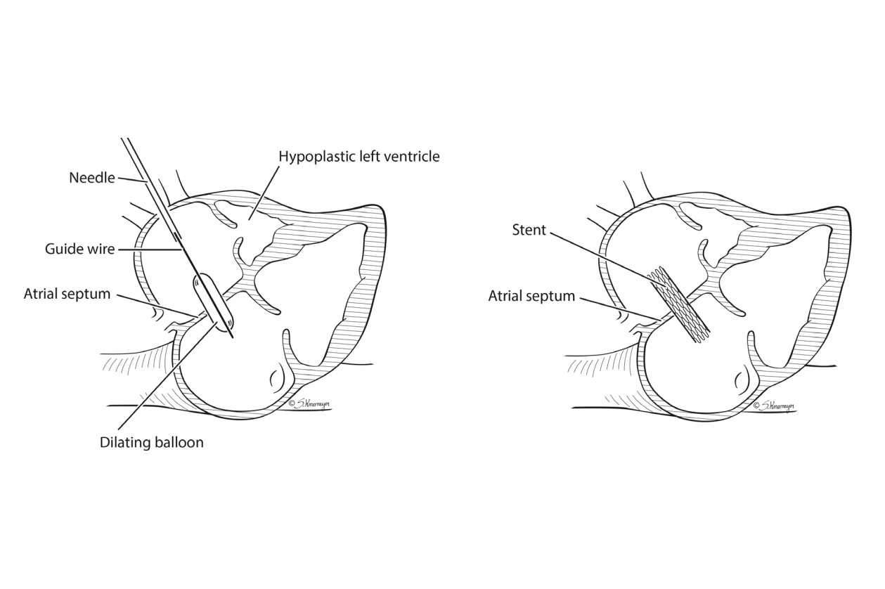 Atrial septal balloon dilation or stent