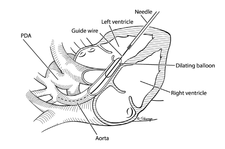 Fetal Cardiac Intervention: Balloon Valvuloplasty