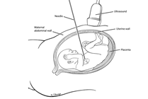 Atrial Septoplasty