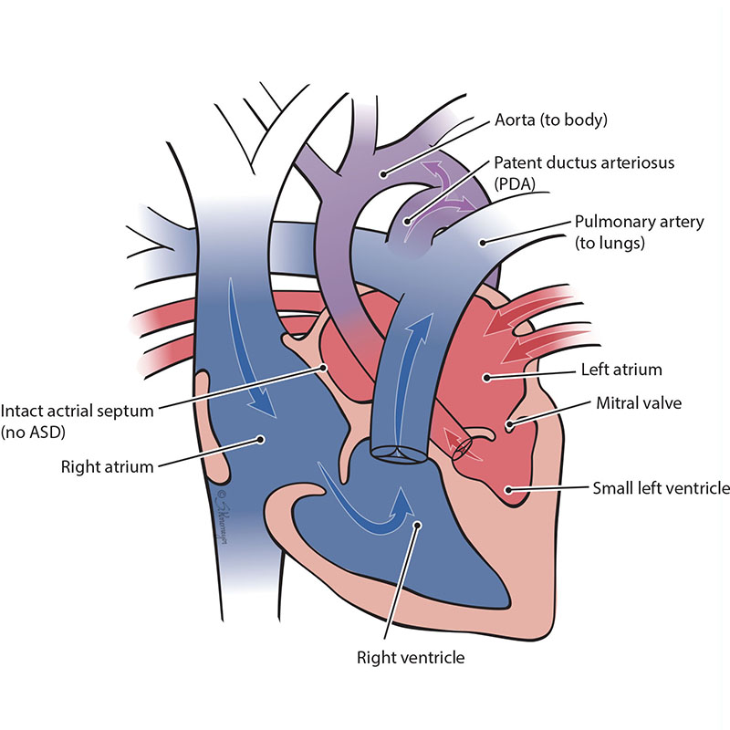 Hypoplastic Left Heart Syndrome with Intact/Restrictive Atrial Septum