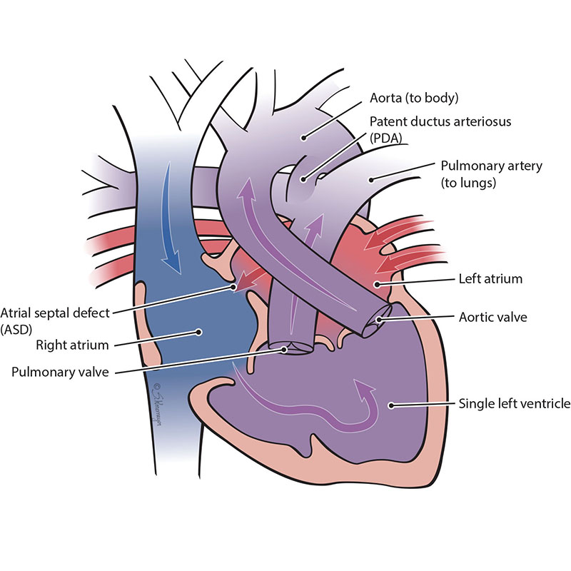 Double Inlet Left Ventricle