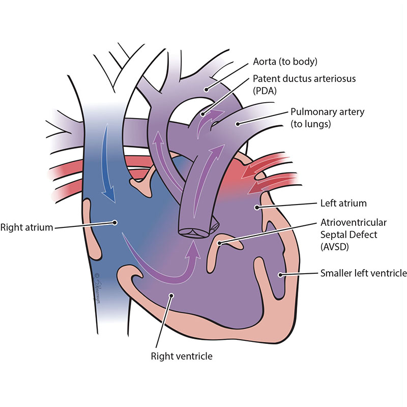 Atrioventricular Septal Defect