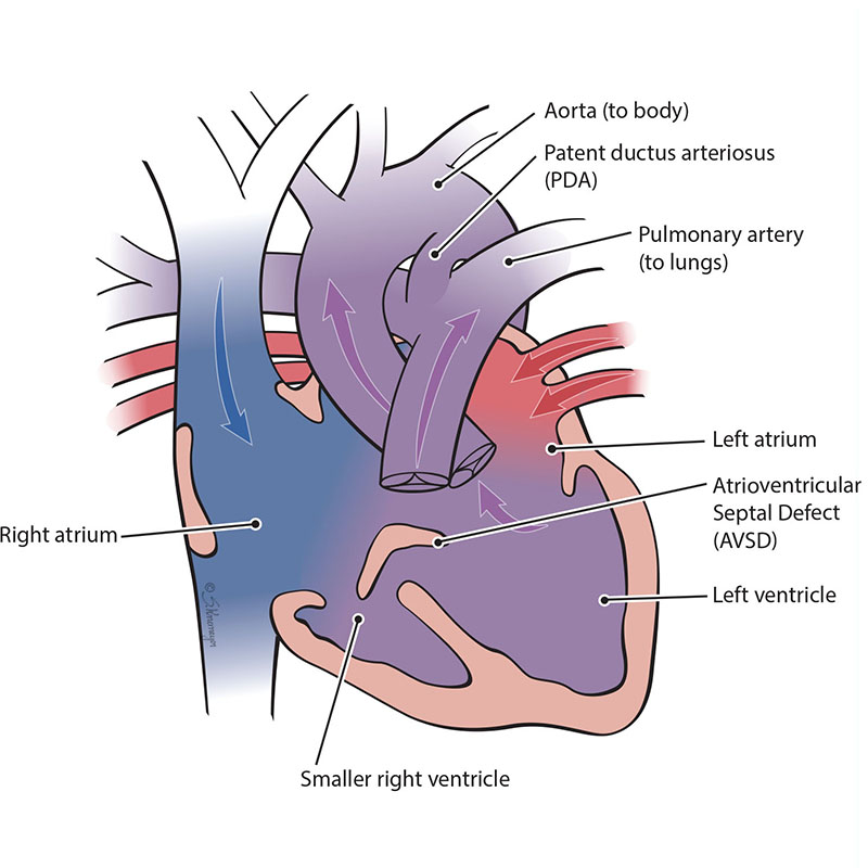 Left-dominant Unbalanced Atrioventricular Septal Defect