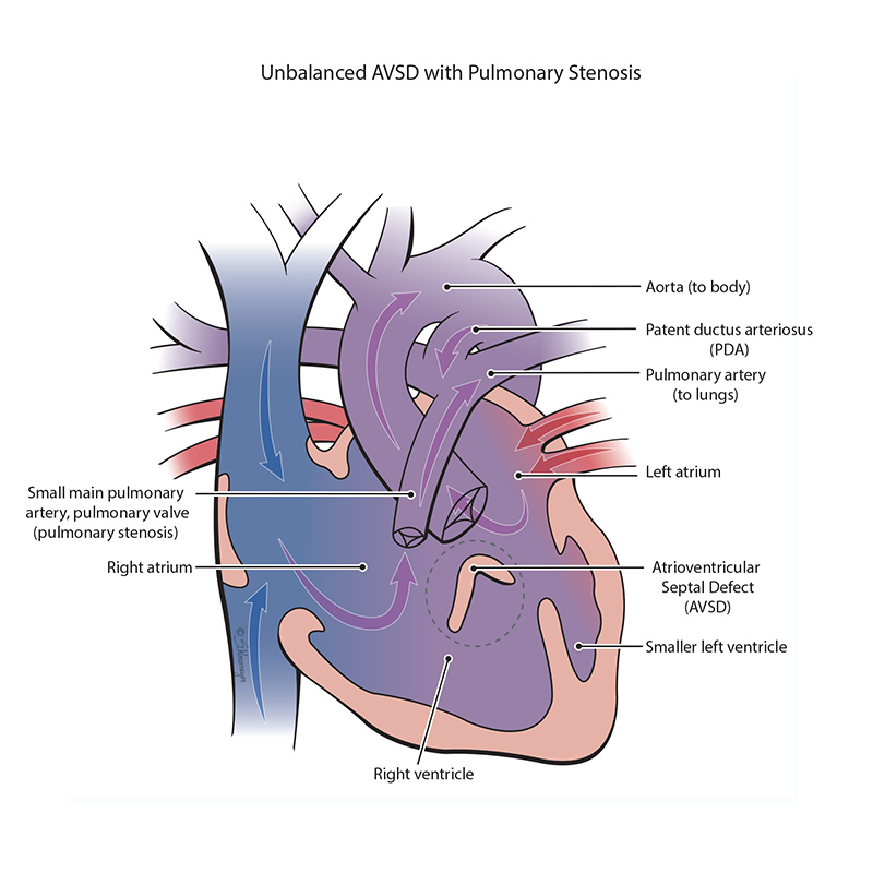 Right-dominant Unbalanced Atrioventricular Septal Defect with Pulmonary Stenosis