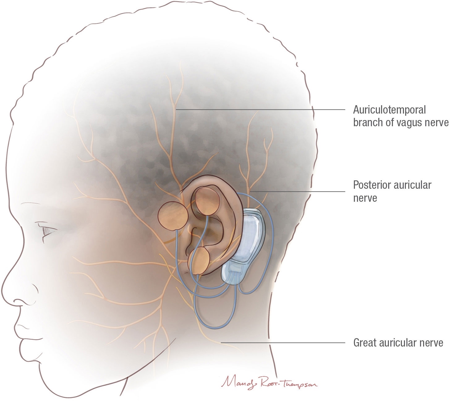 Auricular Nerve Stimulation diagram