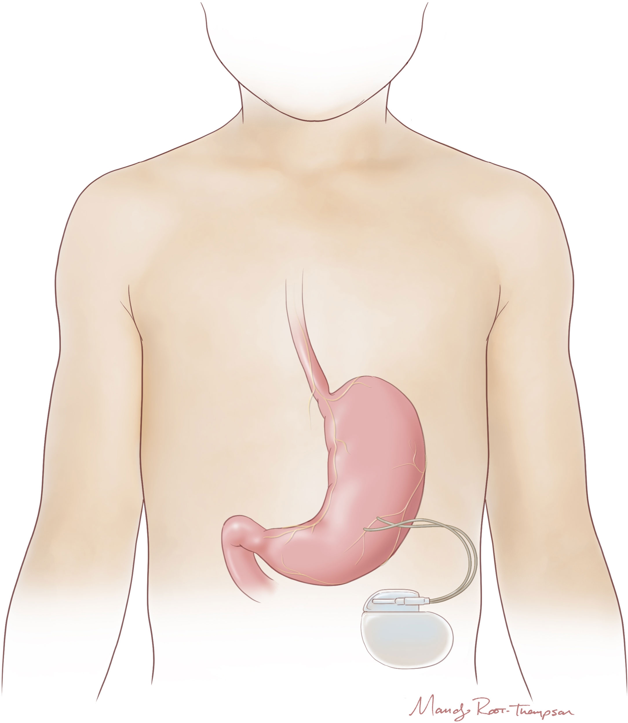 Diagram of a child's stomach showing gastric electrical stimulation treatment.