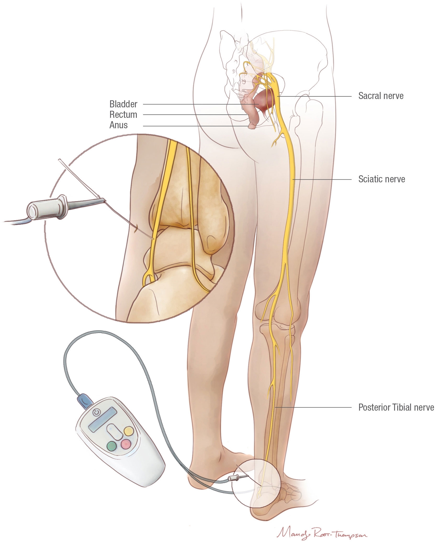 Illustration of posterior tibial nerve stimulation (PTNS), showing a nerve stimulation needle near the ankle connected to a device that sends signals through the tibial, sciatic, and sacral nerves to help treat bladder and bowel dysfunction.