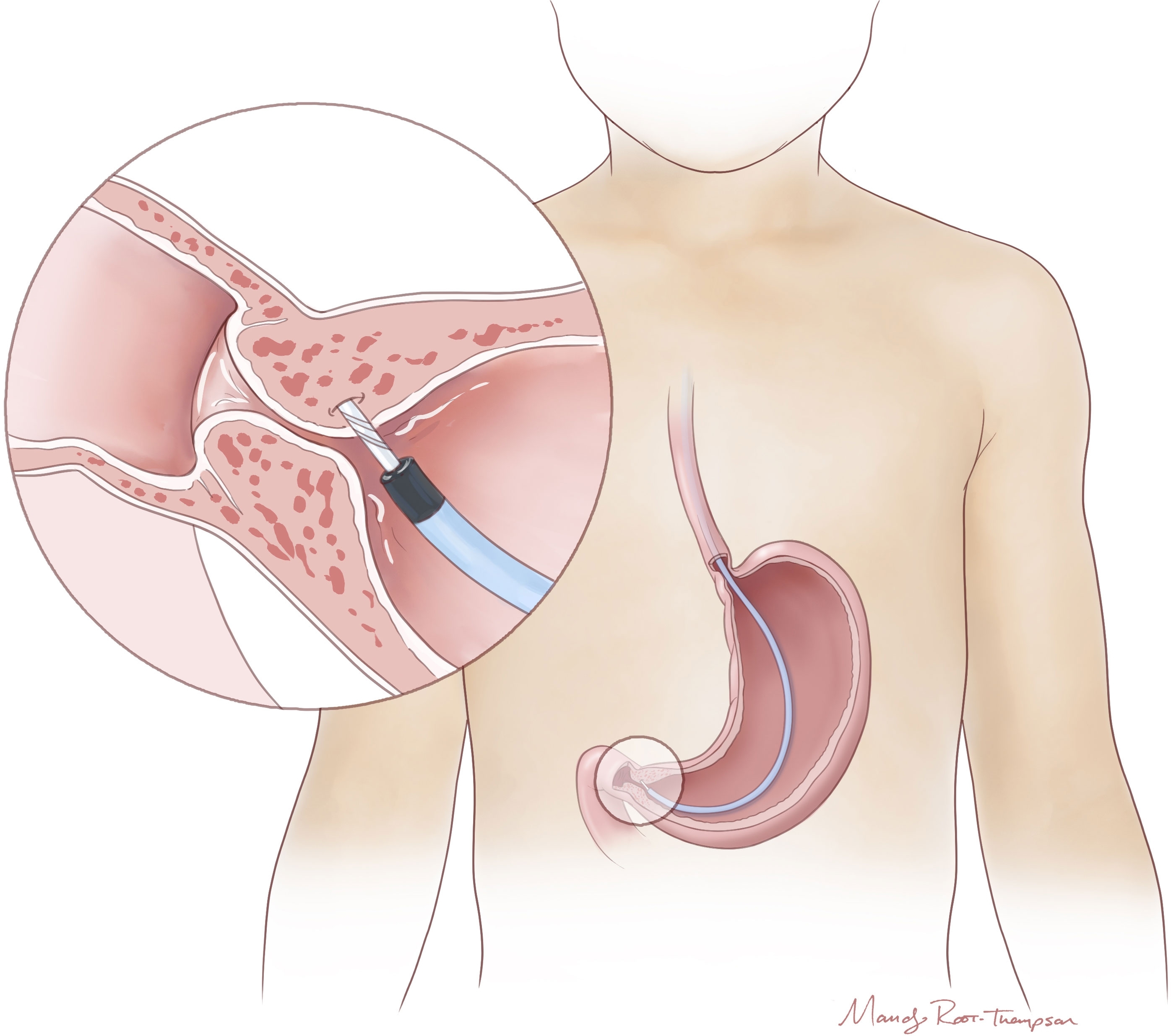Graphic depicting pyloris bot injection into the stomach lining.