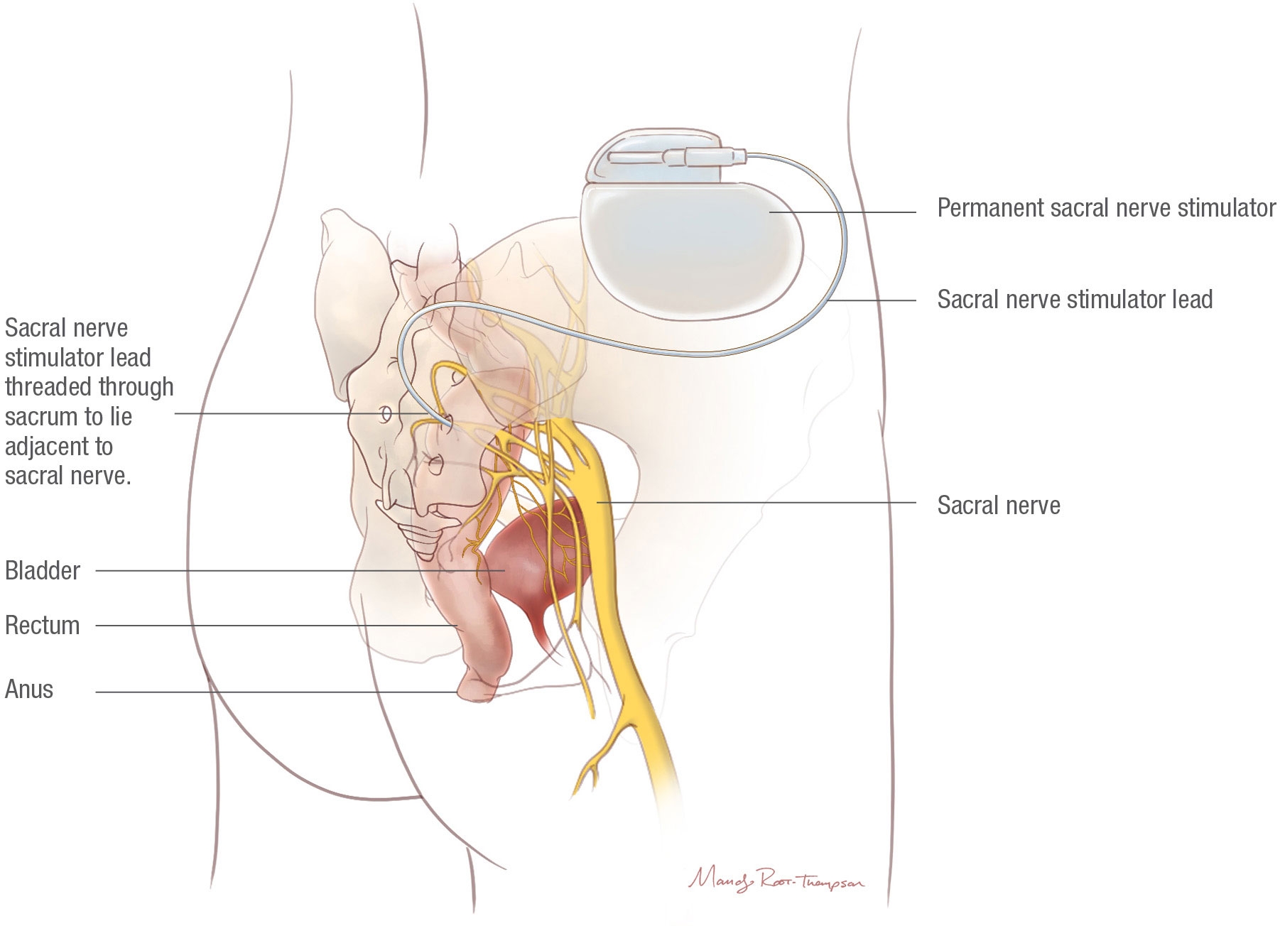 Sacral Nerve Stimulation (SNS)