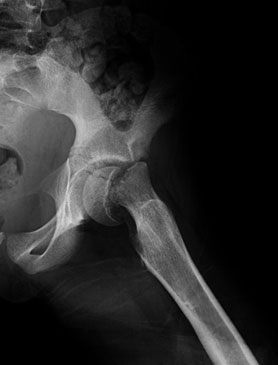Hip Dysplasia Case Study Figure 1