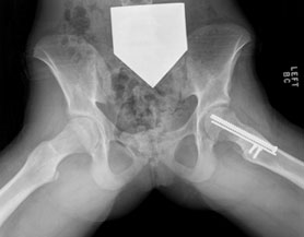Hip Dysplasia Case Study Figure 3