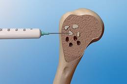 Aneurysmal Bone Cyst Animation