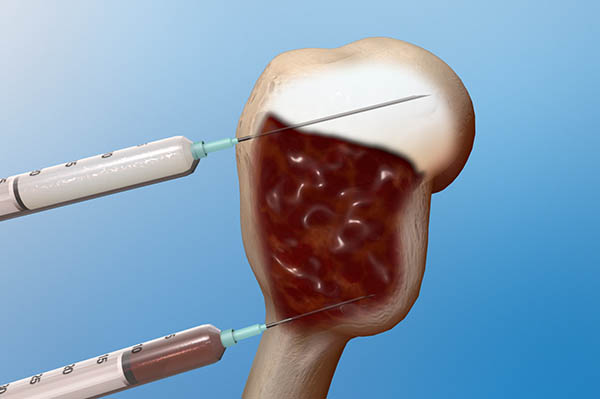 Aneurysmal Bone Cyst