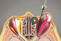 Large Cyst Treatment