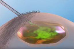 Dermoid Cysts Ablation