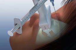 Animation of orbital sclerotherapy to treat a vascular malformation.