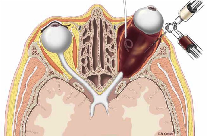 Orbit With Catheter