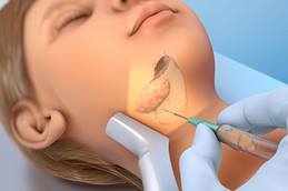 Salivary Gland Ablation Treatment for Ranulas