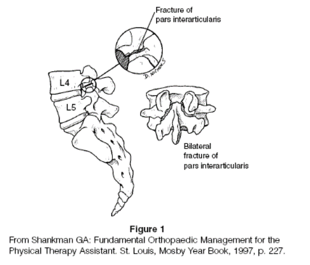 Spondylolysis