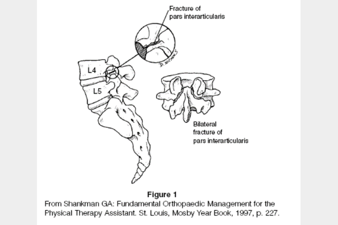 Spondylolysis